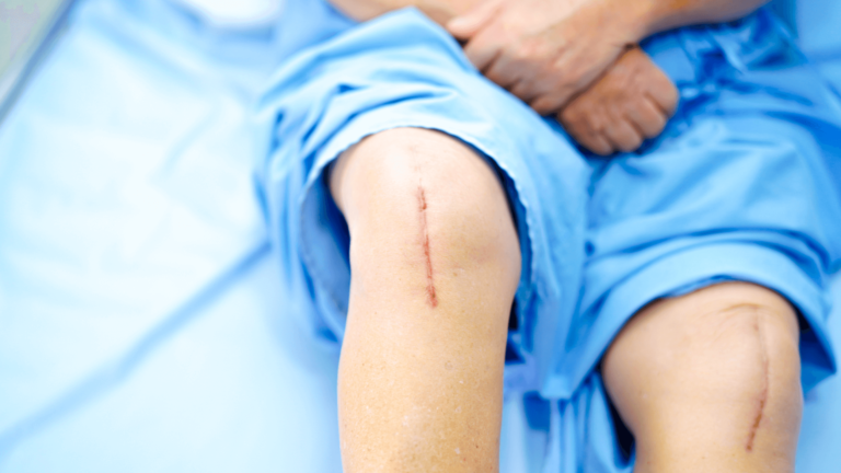 artroplastia do joelho